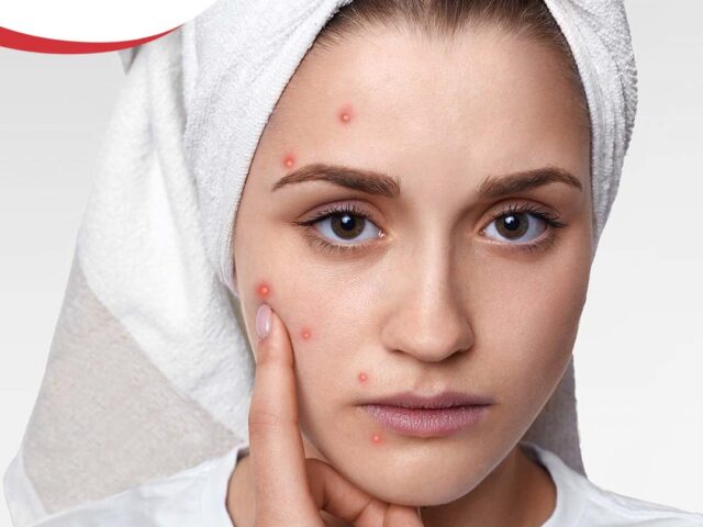 Проблеми со кожата во летниот период?